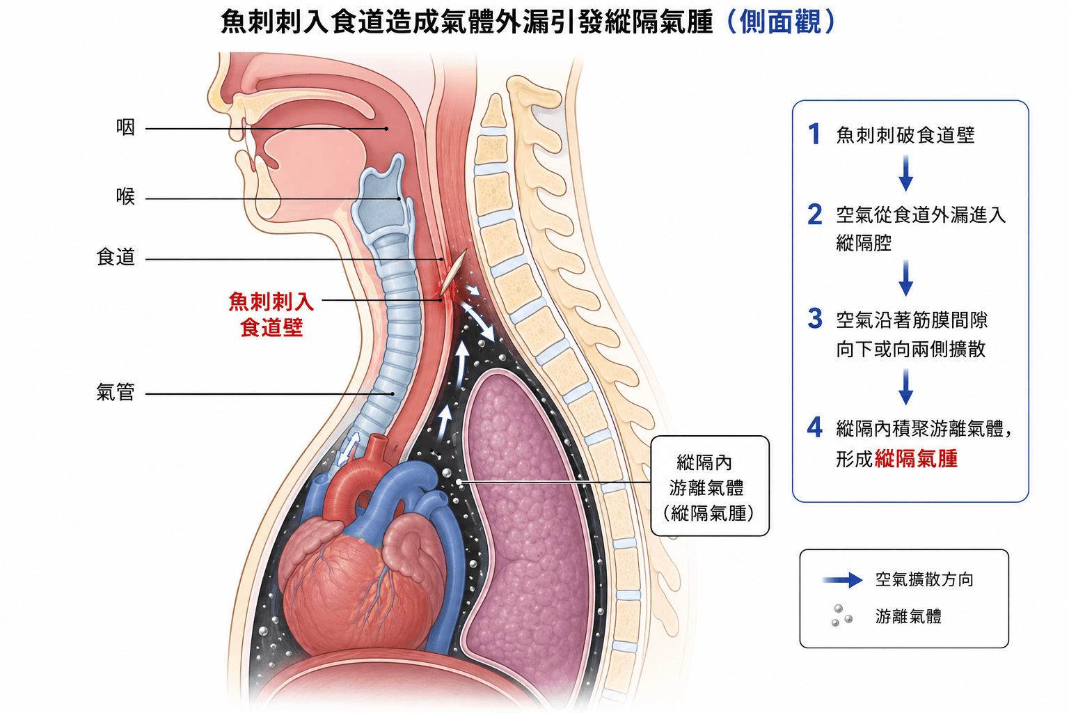 魚刺卡喉嚨常見位置