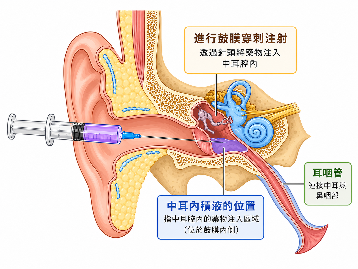 鼓室內類固醇注射示意圖：醫師透過針頭穿過鼓膜，將類固醇藥物直接注入中耳腔內，藥物經圓窗膜滲透至內耳