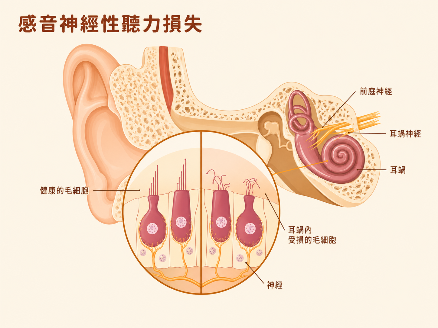 感音神經性聽力損失示意圖：展示內耳耳蝸結構、前庭神經與耳蝸神經的解剖位置，以及健康毛細胞與受損毛細胞的對比